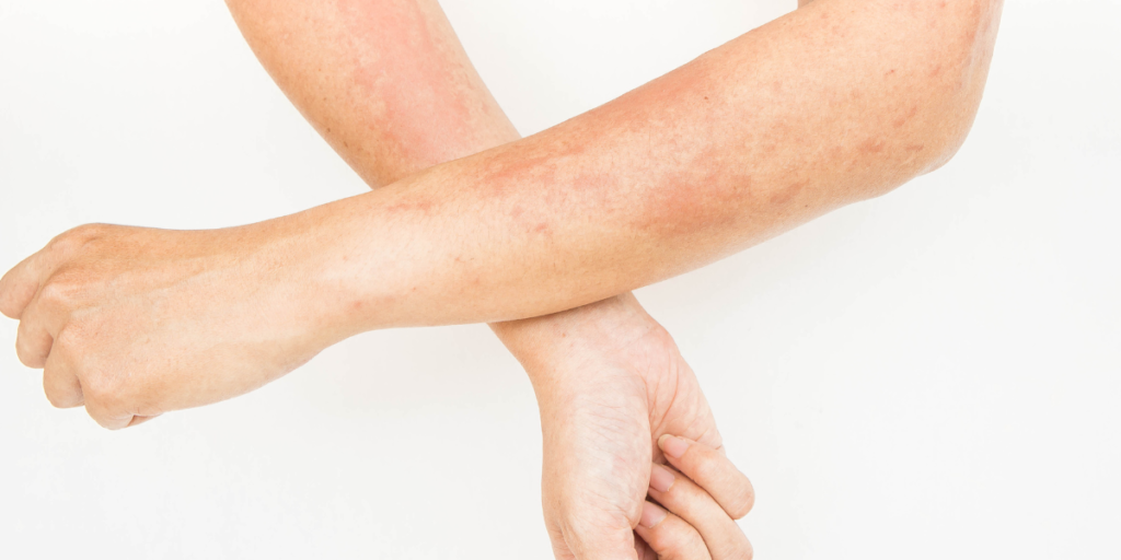 how-to-get-rid-of-contact-dermatitis-fast-and-permanently-research-center